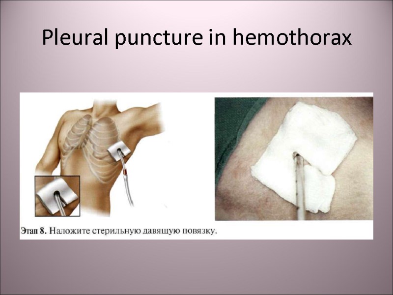 Pleural puncture in hemothorax